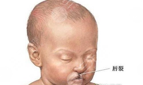 唇腭裂价格