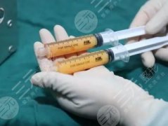脸部自体脂肪填充价格多少钱?2021费用表参考&果图一品! 脸部自体脂肪填充价格多少钱?2021费用表参考&果图一品!