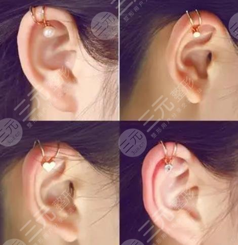 颅耳角在30°-60°之间整形多少钱