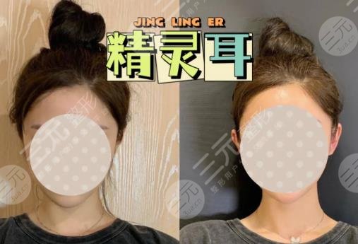 颅耳角在30°-60°之间整形多少钱