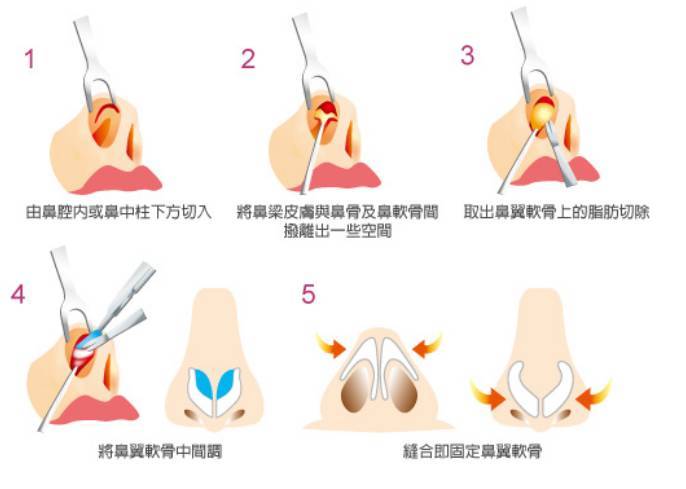 肥厚鼻尖矫正术方法