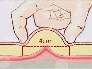 肚子抽脂价格