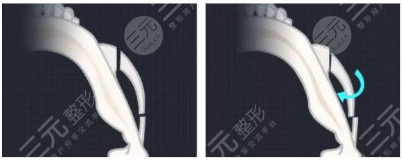 影响颧骨整形价格的因素