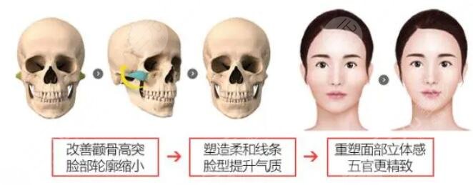 磨颧骨整形手术原理介绍