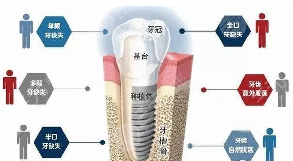 正规医院种植牙收费标准