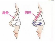 为什么假体隆鼻失败修复一定要3个月?科普解答,美力up不踩雷! 为什么假体隆鼻失败修复一定要3个月?科普解答,美力up不踩雷!