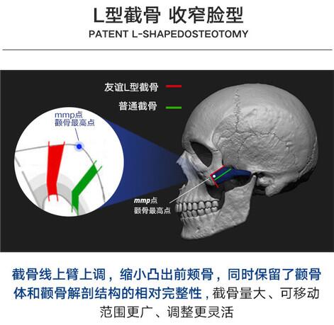 张立天磨骨真的有那么好吗?我的下颌角+颧骨案例,果我i了!
