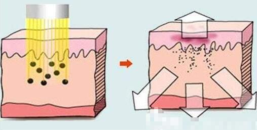 西安西京医院整形美容科科普激光祛斑