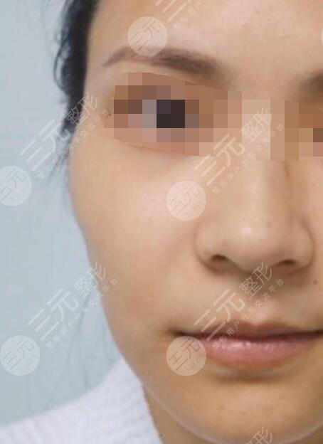 杭州吴永柏脂肪填充前