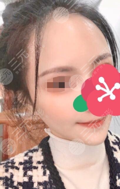 杭州吴永柏脂肪填充后一个月
