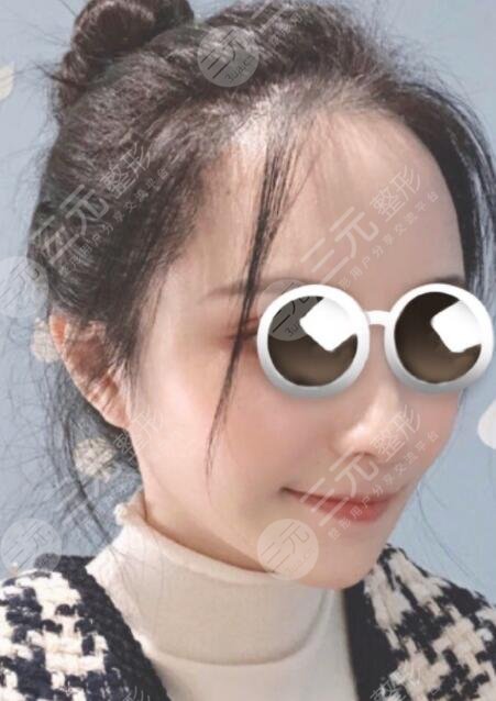 杭州吴永柏脂肪填充后果