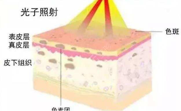 吉大一院光子嫩肤相关科普