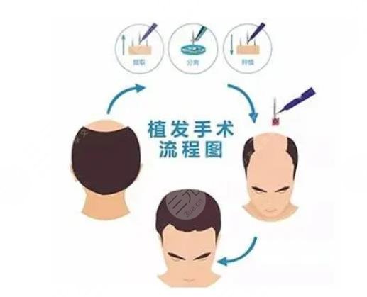 上海九医院植发知识科普