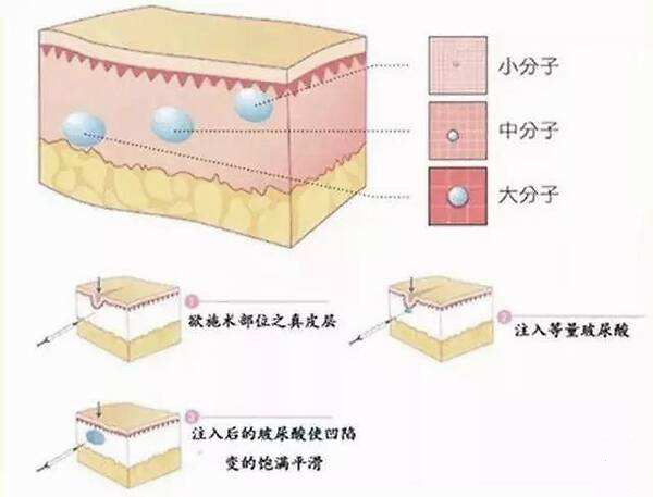 玻尿酸丰下巴多少钱