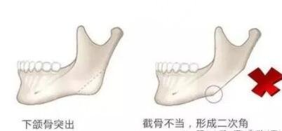 下颌角截骨术属于几级手术