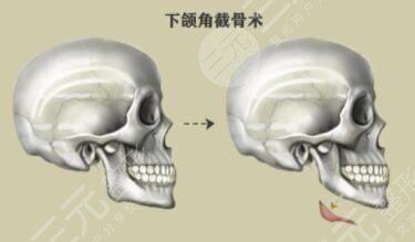 下颌角截骨方法的选择