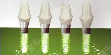 种植牙登腾和奥齿泰哪个好