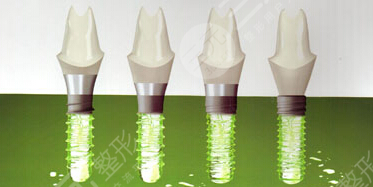 瑞士种植体iti三种档次