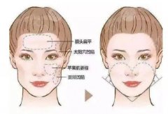 面部填充需要多少钱?2021价格攻略来袭!附真人案例,惊艳种草! 面部填充需要多少钱?2021价格攻略来袭!附真人案例,惊艳种草!