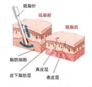 光纤溶脂和吸脂的区别科普！哪个果好？案例附上，塑形全指南！