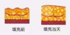 夏天做脂肪填充好不好,有利于恢复吗?面填指南!分享果图&价格! 夏天做脂肪填充好不好,有利于恢复吗?面填指南!分享果图&价格!
