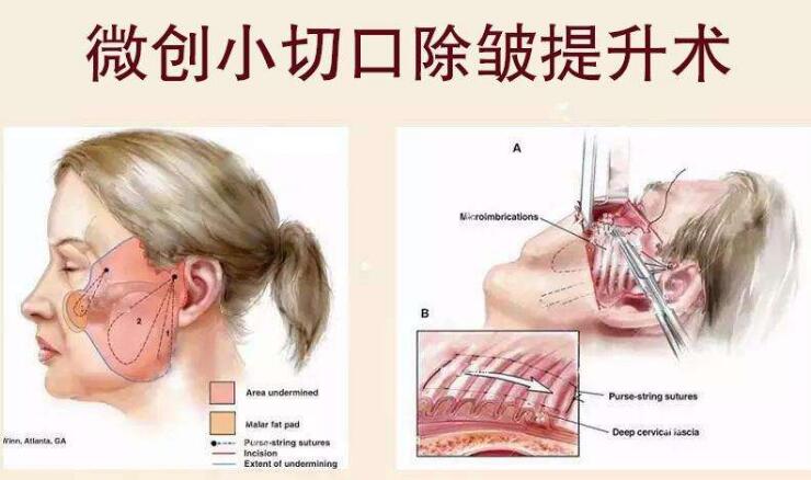 北京加减美拉皮手术专家科普知识