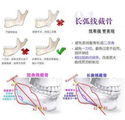 做磨骨手术的价格是多少