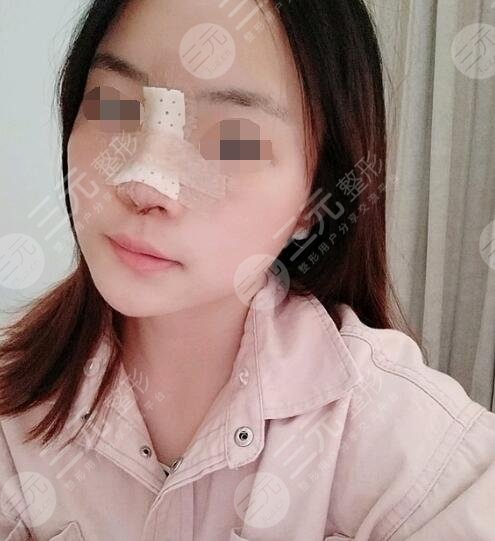 假体隆鼻术后7天