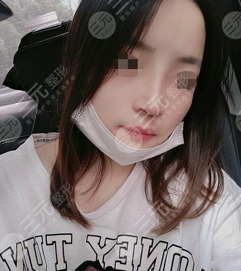 假体隆鼻术后2个月