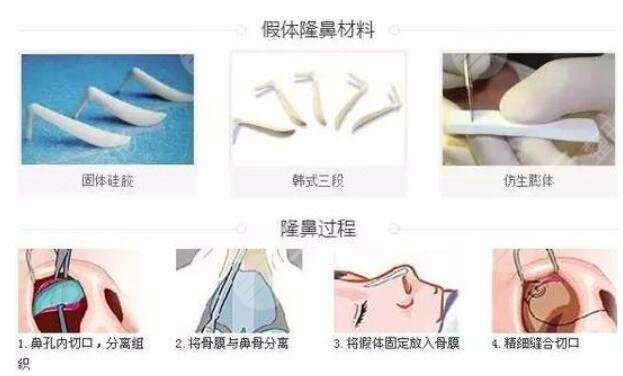 假体隆鼻可以保持一辈子吗