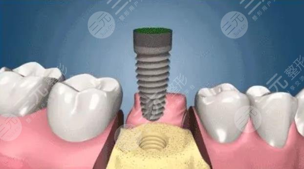 种植牙的过程步骤