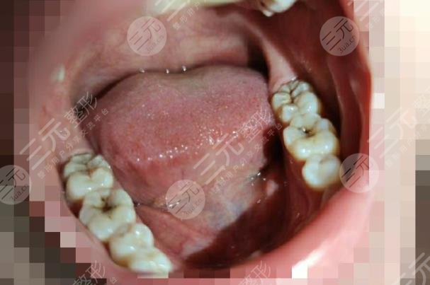 武汉大学口腔医院牙齿修复案例分享