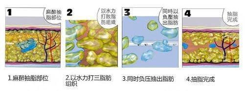 水动力吸脂术的好处