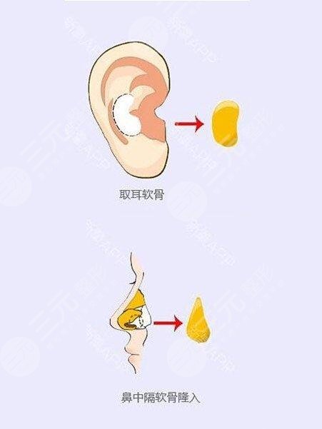 杨群申医生耳软骨隆鼻科普相关问答