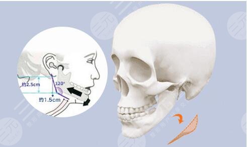 下颌角整形手术注意事项