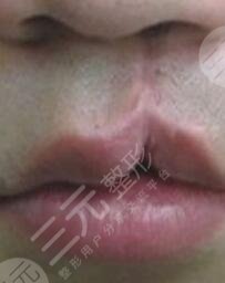 唇腭裂修复术前