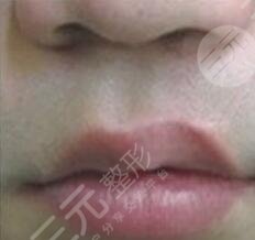 唇腭裂修复术后