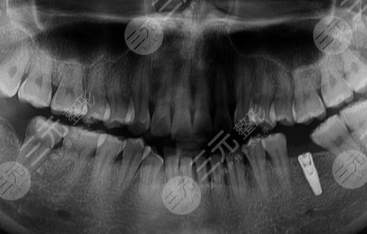 昆明雅度口腔医院种植牙案例分享
