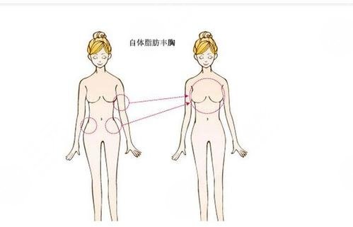 上海隆胸专家余力自体脂肪隆胸科普：适合人群