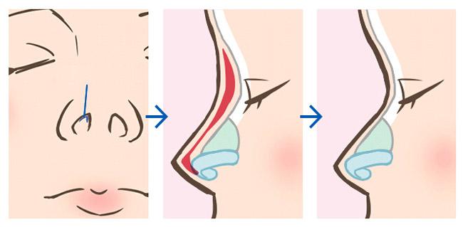 什么是硅胶隆鼻假体取出