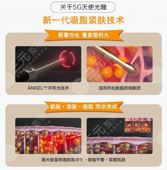 什么是光纤溶脂