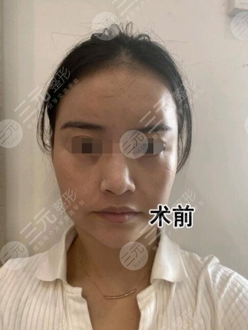 亲身体验“除皱秘籍”拉皮果术前