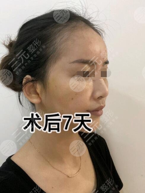 亲身体验“除皱秘籍”拉皮果术后7天