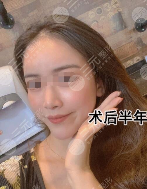 亲身体验“除皱秘籍”拉皮果术后果