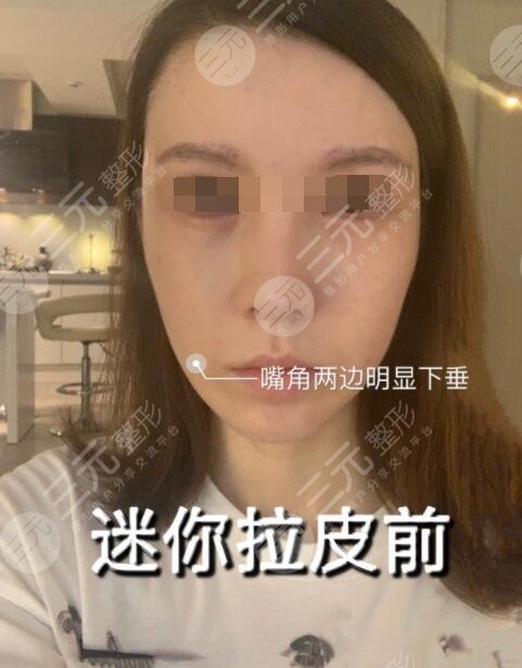 除皱术前