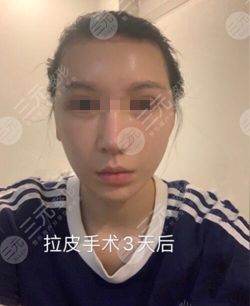 除皱术后3天