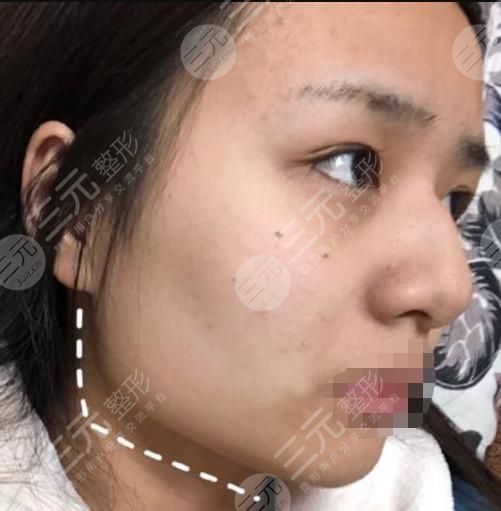 磨骨手术术前