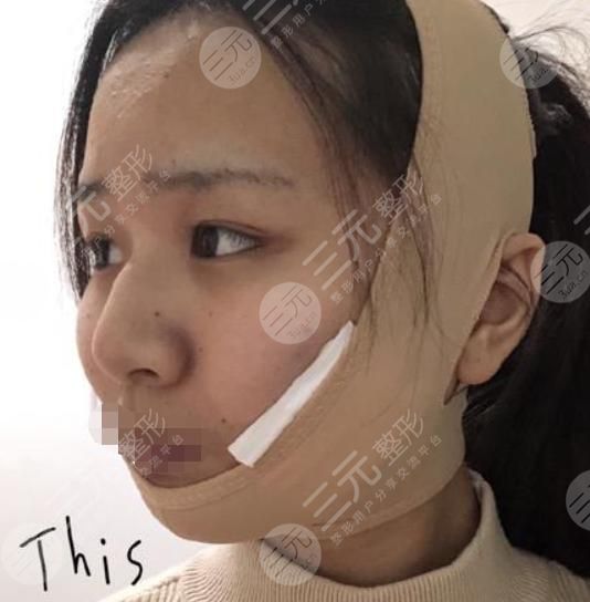 磨骨手术术后5天