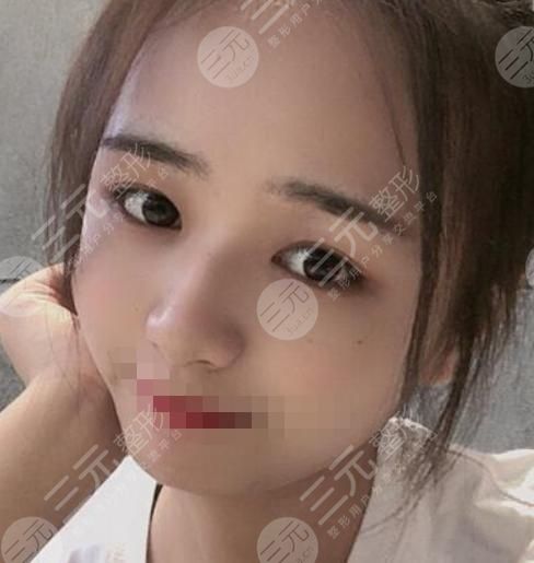 磨骨手术术后35天