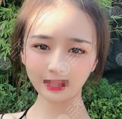 磨骨手术术后18天